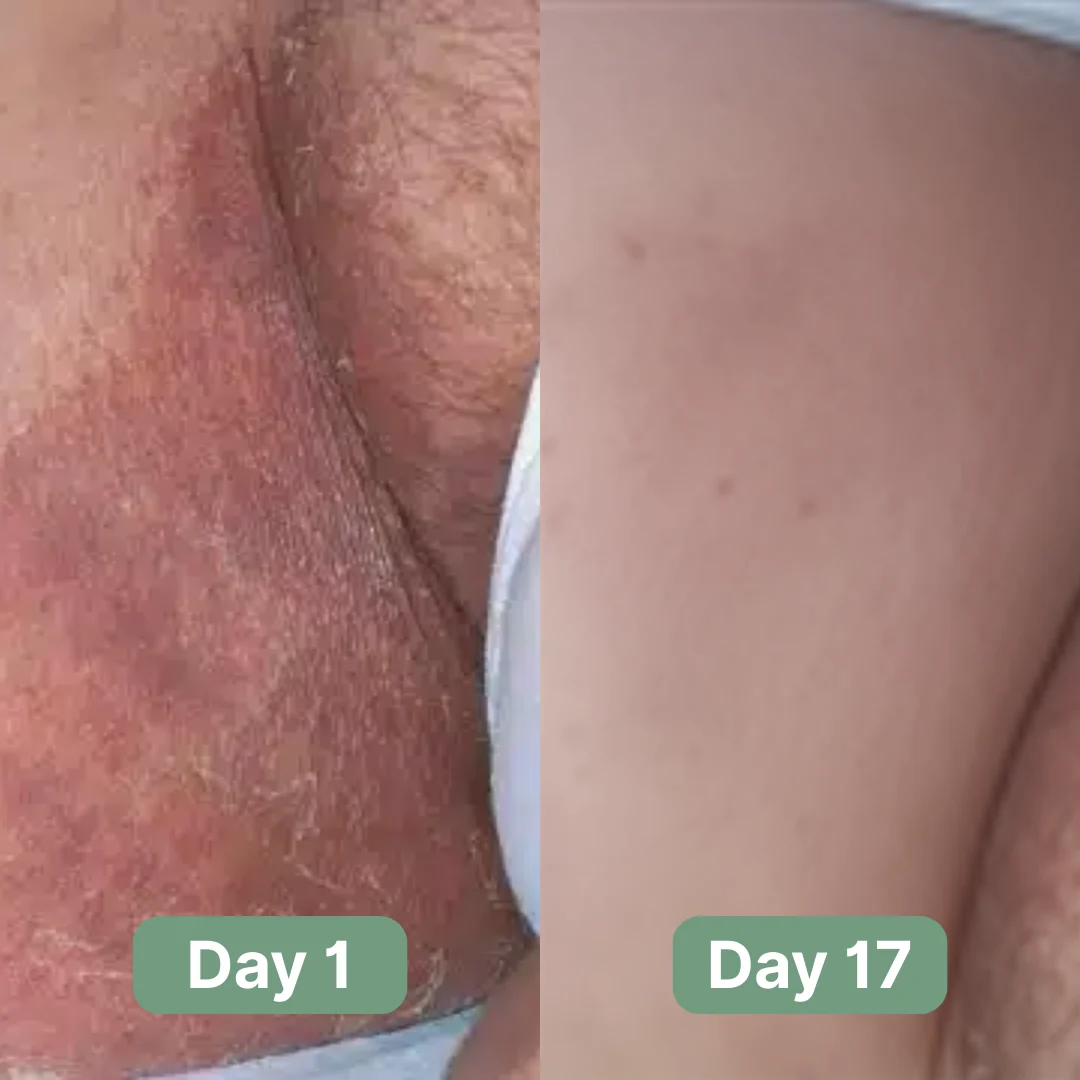 Nirast Antifungal Soap®