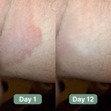 Nirast Antifungal Soap®