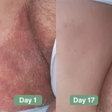 Nirast Antifungal Soap®