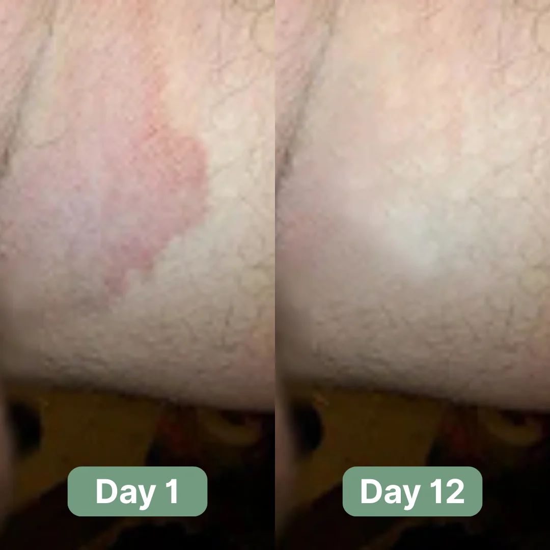Nirast Antifungal Soap®